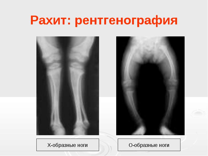 Юу хийх вэ? Хүүхэд рахит: шинж тэмдэг, эмчилгээ. Хүүхэд рахитыг хэрхэн яаж сэргийлэх вэ? Хүүхдэд рахитын бусад шинж